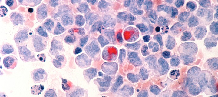 Лейкозные клетки