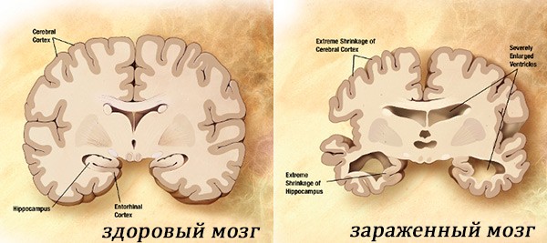 Здоровый и зараженный мозг