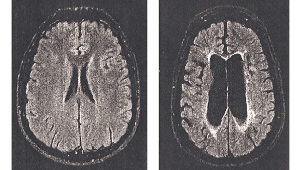 Рентген зараженного и здорового мозга